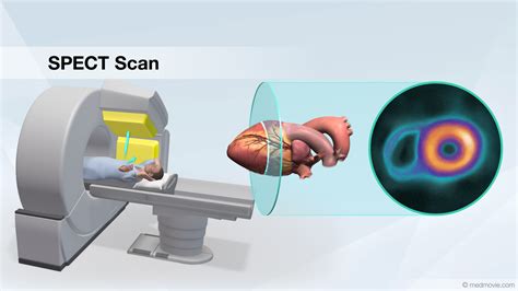 Spect Scan