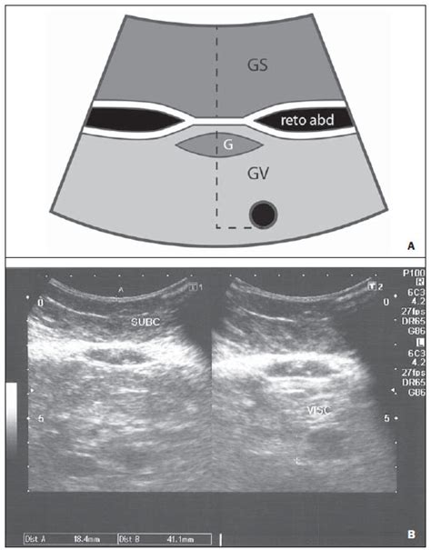 Radiologia Brasileira O Papel Da Ultrassonografia Na Medida Da