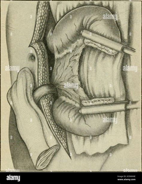 Fistula Intestinal Hi Res Stock Photography And Images Alamy