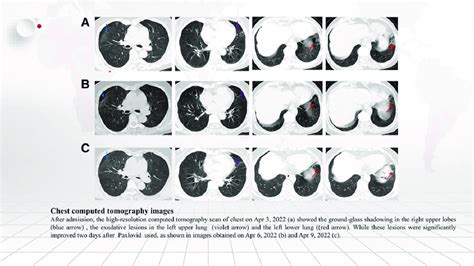 Chest Computed Tomography Images After Admission The High Resolution