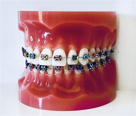 Red Bank Orthodontics - Traditional Braces