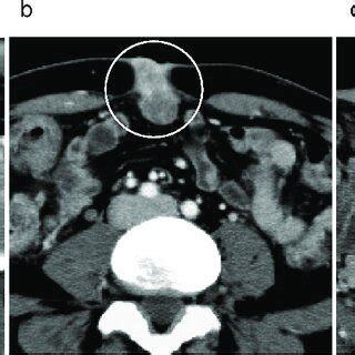 A Contrast Enhanced CT Findings Before Treatment CT Showed Ascending