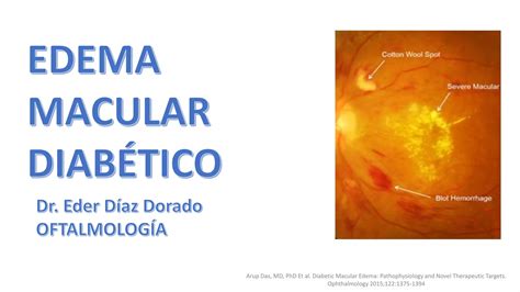 Edema Macular Diabetico O Ppt