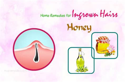 16 Effective Home Remedies For Ingrown Hairs Cyst