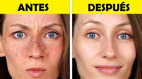 Cómo eliminar pecas de la cara lilimpieza