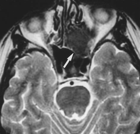 Fibrous Dysplasia Involving The Base Of The Skull Ajr