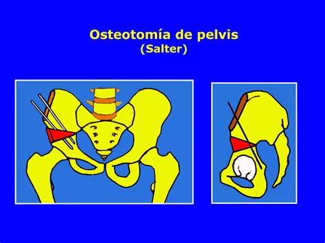 10 Luxacion Congenitadecadera Ppt