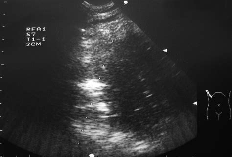 Radiofrequency Ablation Of Recurrent Hepatocellular Carcinoma After