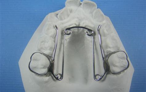 Quad Helix Rapid Palatal Expander Orthodontic Model – Buyamag INC