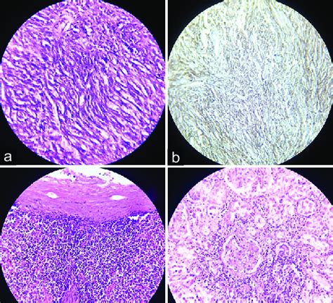 A Photomicrograph Showing Neoplasm Composed Of Bland Spindle Cells Download Scientific