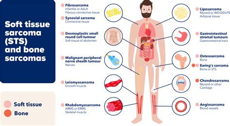 Soft Tissue Sarcoma Symptoms And Cancer Treatment Medstar Health