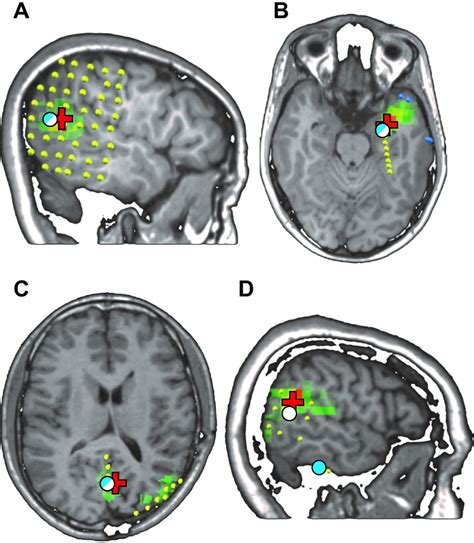 Electric Source Imaging Of Interictal Activity Accurately Localises The