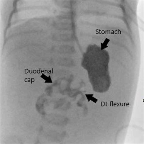 Fluoroscopic Image Of The Upper Gi Contrast Examination Shows Normal