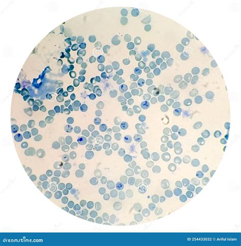 Reticulocyte Count Under Microscope, 40x. Methylene Blue Staining Stock ...