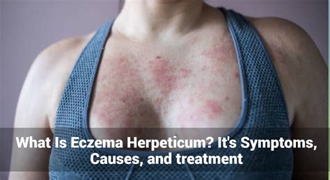 What Is Eczema Herpeticum? It’s Symptoms, Causes, and treatment ...