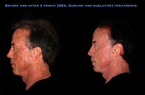 Before And After Elos Treatments — Drs Mooney And Berry