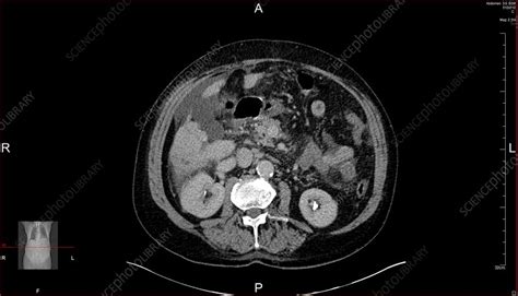 Liver cancer, CT scan - Stock Image - C019/9565 - Science Photo Library