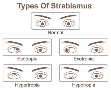 The Cost Of Strabismus Surgery Or Correction Nvision