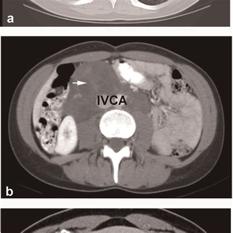 Computed Tomography Scans Of Patients With Lymphangioleiomyomatosis