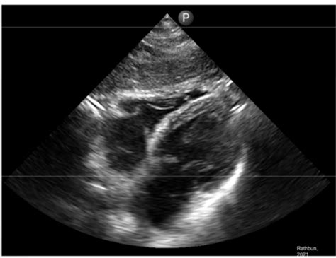 Cardiac Ultrasound And Thorax Imaging Flashcards Quizlet