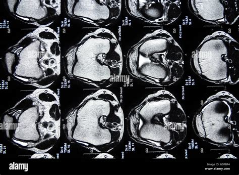 Risonanza Magnetica Imaging Mri Immagini E Fotografie Stock Ad Alta