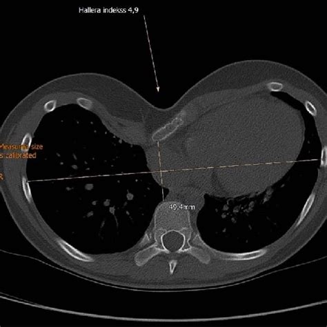 Preoperative Computed Tomography Demonstrating Severe Pectus Excavatum Download Scientific