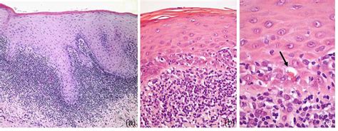 Oral Lichen Planus Intechopen