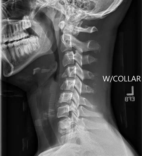 Flexion Vs Extension Teardrop Fracture