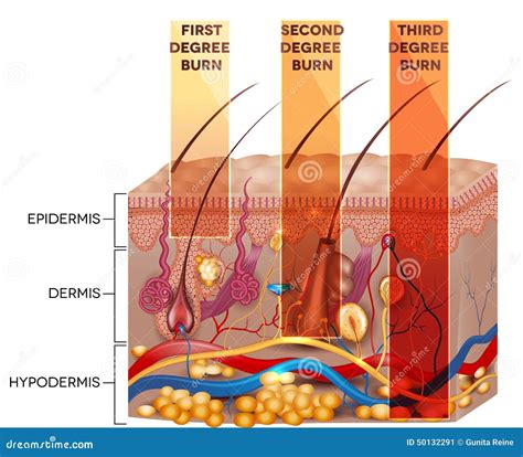 Third Degree Burn Stock Illustrations 57 Third Degree Burn Stock