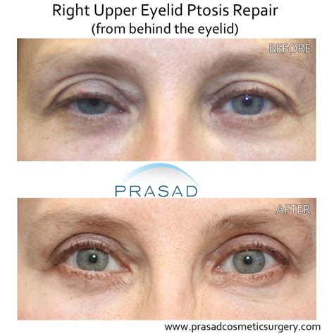 Eyelid Ptosis Causes Possible Neurological Causes Dr Prasad