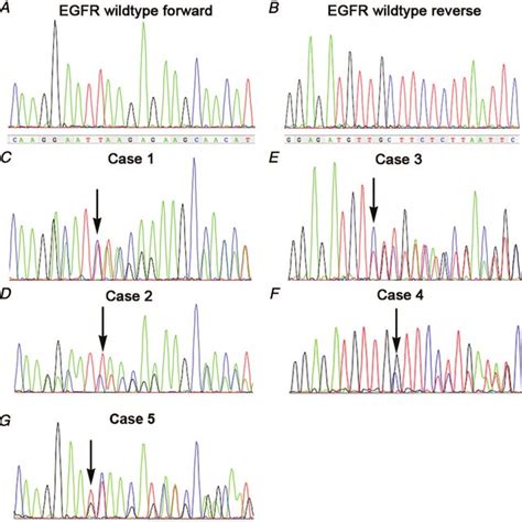 Epidermal Growth Factor Receptor EGFR Sequence Analysis Results Of