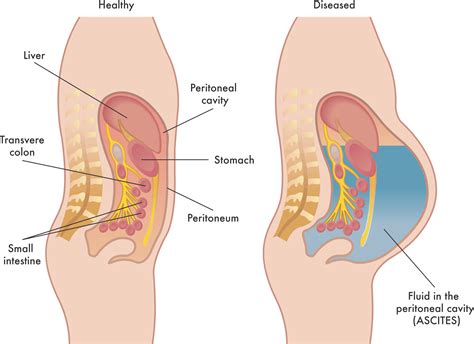 What Causes Ascites MEDizzy