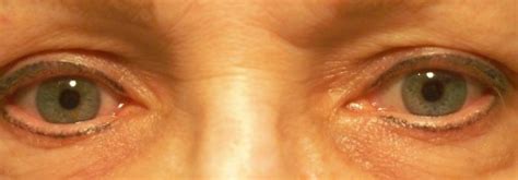 Mechanical Ptosis Surgery Philadelphia Pa Marlton Nj