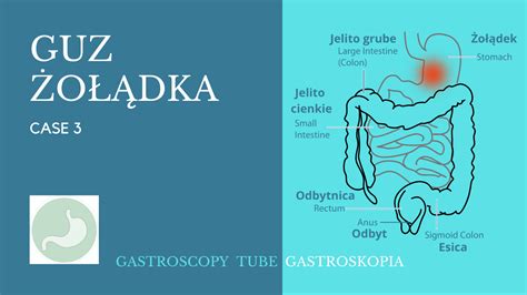 Gastroskopia Case Guz O Dka Poradnik Gastrologiczny