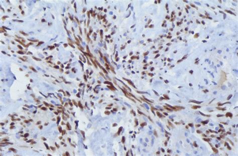 Primary Intraosseous Kaposis Sarcoma Presenting As An Asymptomatic