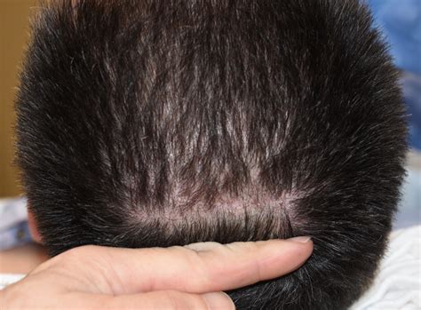 appearance  scalp scars  custom skull implants explore