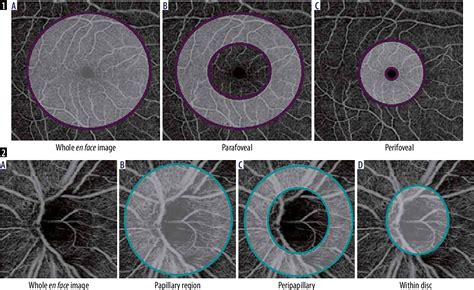 Figure 1 From Evaluation Of Ocular Blood Flow In Glaucoma