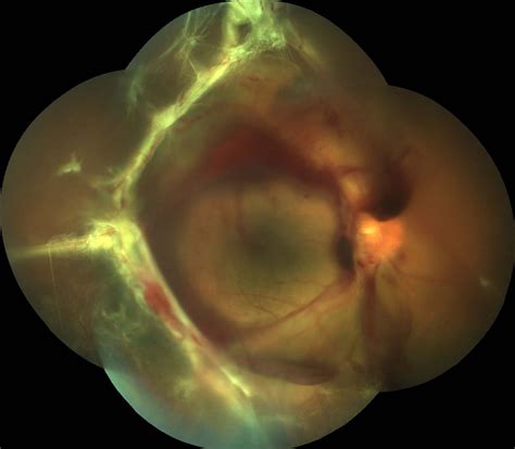 Vitrectomy Retinal Detachment