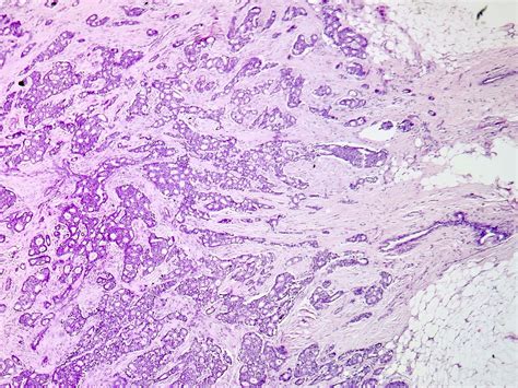 Cribriform Adenocarcinoma