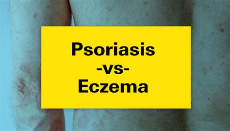 Psoriasis vs. Eczema: Understanding the Differences and Effective ...