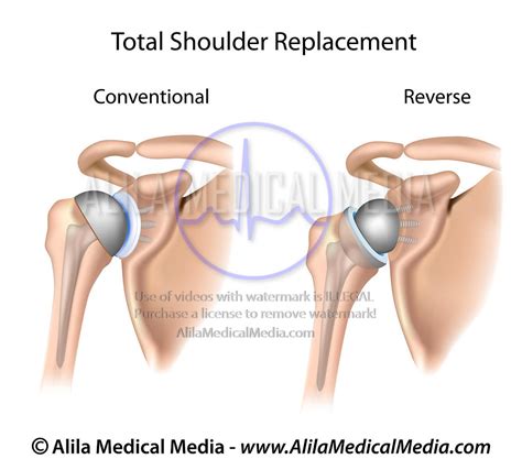 Alila Medical Media Orthopaedics And Sport Medicine Images And Videos