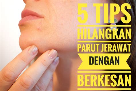 5 Tips Hilangkan Parut Jerawat Dengan Berkesan Pengedar Shaklee Machang