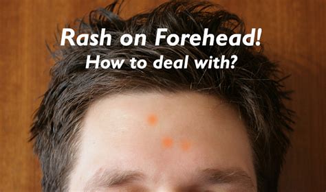 Rash On Forehead Causes Symptoms Treatments All Rash