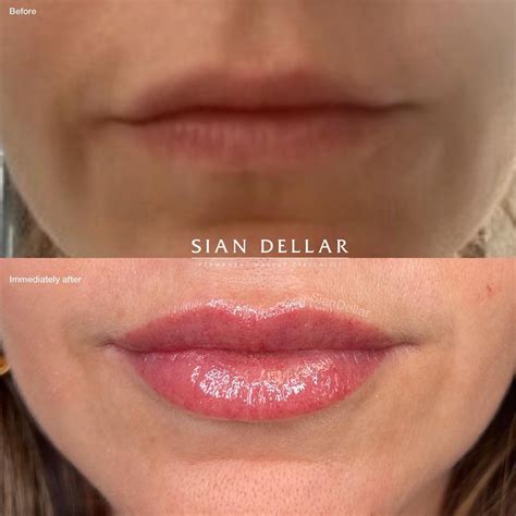 Lip Blush Enhancement By Sian Sian Dellar