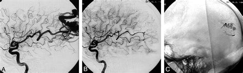 Brain Avm Embolization With Onyx American Journal Of Neuroradiology