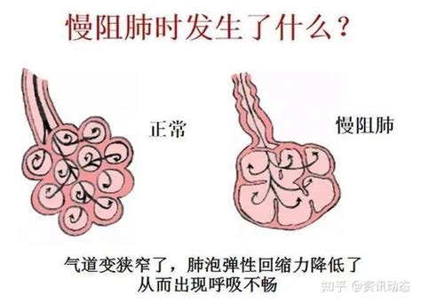 健康科普：一文带你了解“沉默的杀手”慢阻肺及其预防与治疗！ 知乎