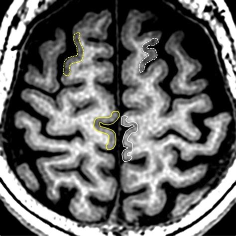 Relationship Of The Paracentral Lobule With Other Structures The