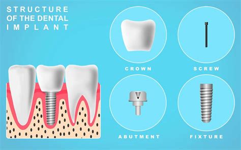 Are The Materials Of Dental Implants Safe Dentist Radlett