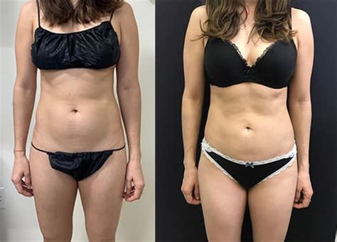 Abs Waist Liposuction Before After Neinstein Plastic Surgery