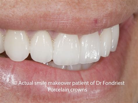 Porcelain Crowns | Types and Uses of a Porcelain Crown